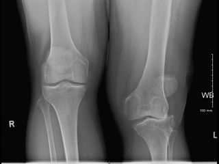 Ankota Home Care blog - knee X-Ray